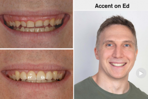 dental aesthetic course in auckland Accent Dentists