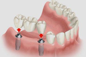 Tooth Replacement With Dental Implants